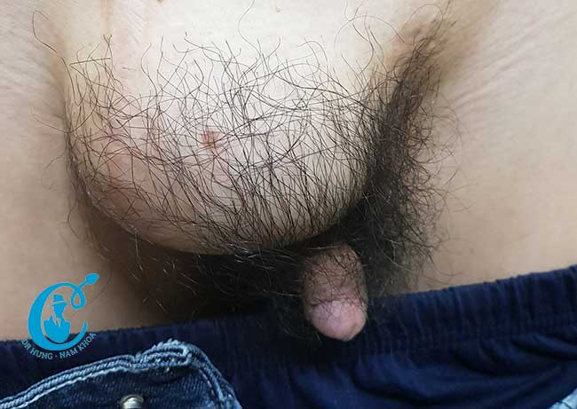 Sưng to do ung thư tinh hoàn