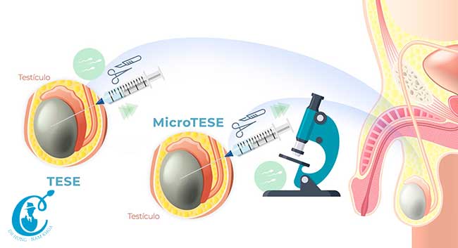 Phẫu thuật Tese và Tesste Micro