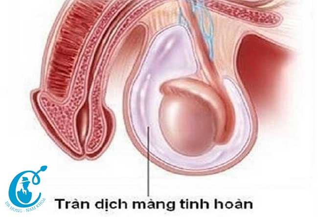 Biểu hiện tràn dịch màng tinh hoàn
