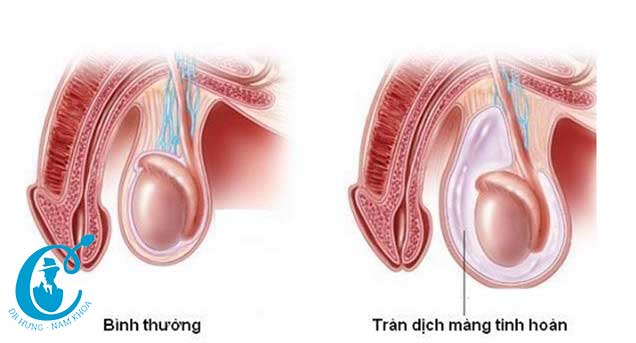 Hình ảnh tinh hoàn bình thường và tràn dịch màng tinh hoàn