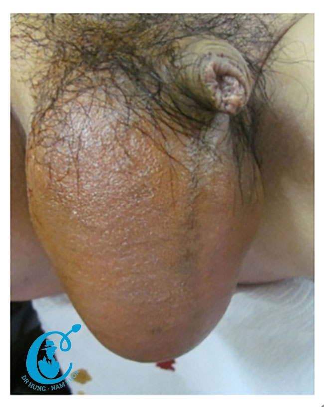 Hình ảnh bìu phồng to do bị tràn dịch màng tinh hoàn