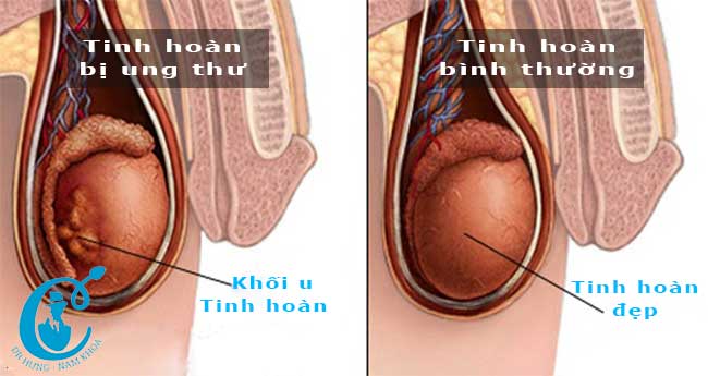 Sờ nắn thấy có sần rất dễ là ung thư tinh hoàn