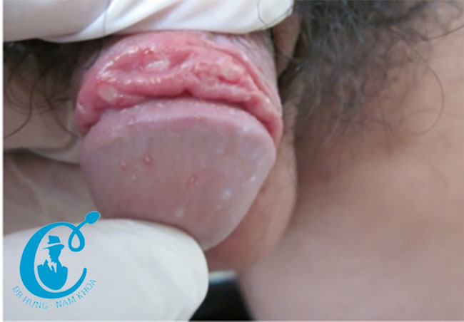 Hình ảnh viêm quy đầu và bao quy đầu với những nốt chấm đỏ ở quy đầu và loét chợt ở bao quy đầu.