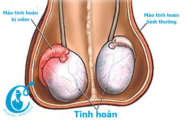 Viêm mao màng tinh xảy ra ở bất cứ nam giới