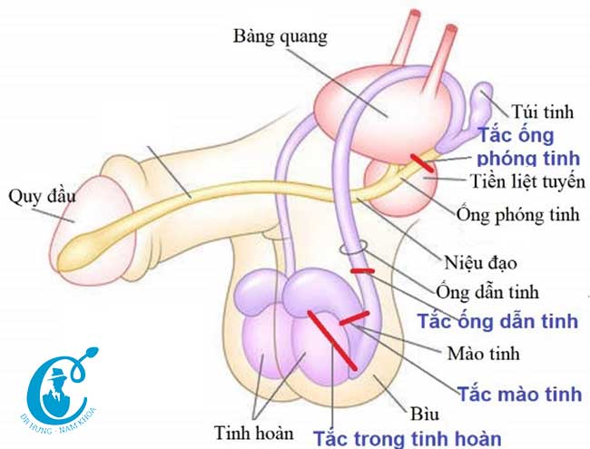 Các vị trí tắc của đường dẫn tinh màu đỏ