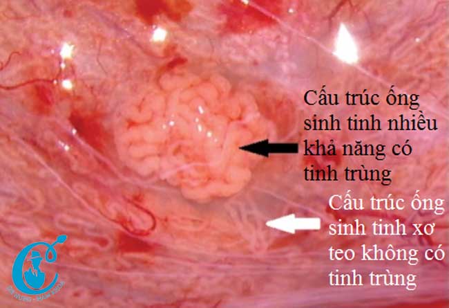 Điều trị vô sinh không bế tắc bằng phương pháp phẫu thuật