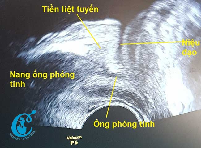 Giãn ống dẫn tinh dạng nang trên hình ảnh siêu âm của chúng tôi