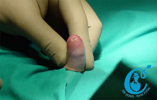 Trẻ nhỏ bị hẹp bao quy đầu cần nong tách